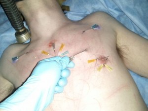 Removing Needles