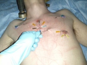 Removing Needles