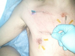 Removing Needles