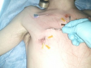 Removing Needles