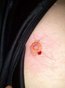 Overhead shot of bleeding nipple with elasticator bands