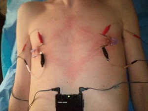 Electrocuting the nipples via needles