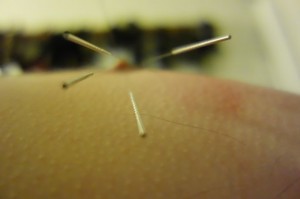 Acupuncture in nipple