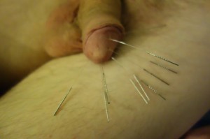 Acupuncture needles in cock